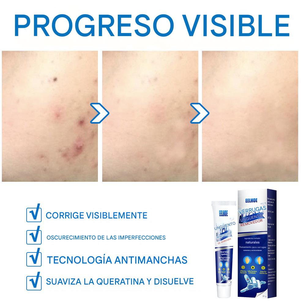 CREMA REMOVEDORA DE VERRUGAS, Piel limpia, segura y libre de preocupaciones.
