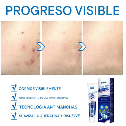CREMA REMOVEDORA DE VERRUGAS, Piel limpia, segura y libre de preocupaciones.