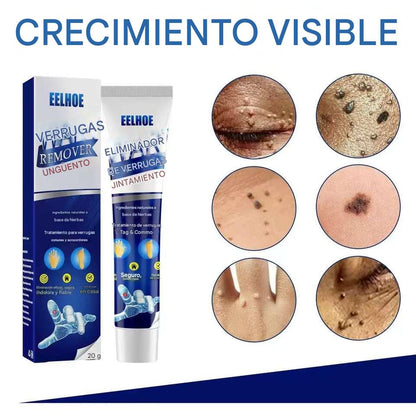 CREMA REMOVEDORA DE VERRUGAS, Piel limpia, segura y libre de preocupaciones.