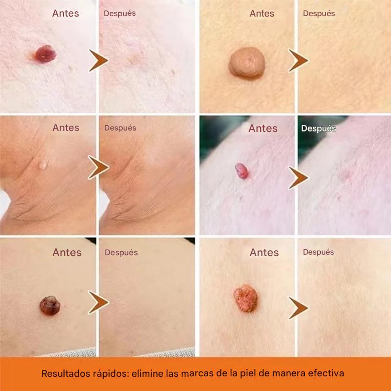 CREMA REMOVEDORA DE VERRUGAS, Piel limpia, segura y libre de preocupaciones.