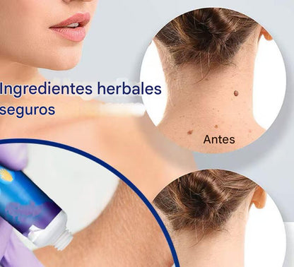 CREMA REMOVEDORA DE VERRUGAS, Piel limpia, segura y libre de preocupaciones.