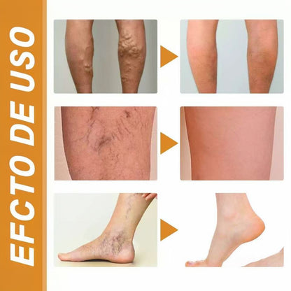 Alivio Natural para Venas y Piernas