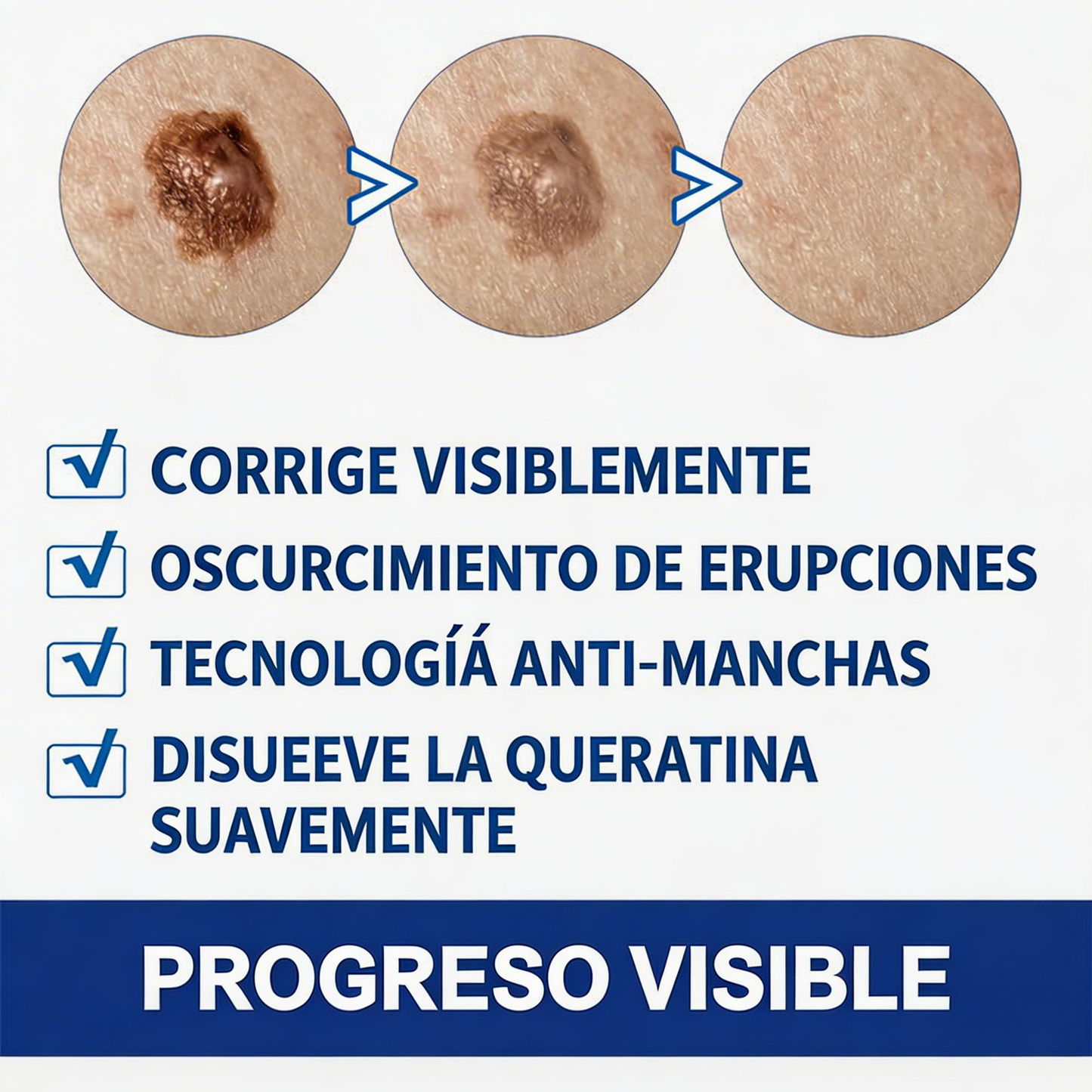 CREMA REMOVEDORA DE VERRUGAS, Piel limpia, segura y libre de preocupaciones.