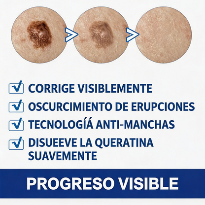 CREMA REMOVEDORA DE VERRUGAS, Piel limpia, segura y libre de preocupaciones.