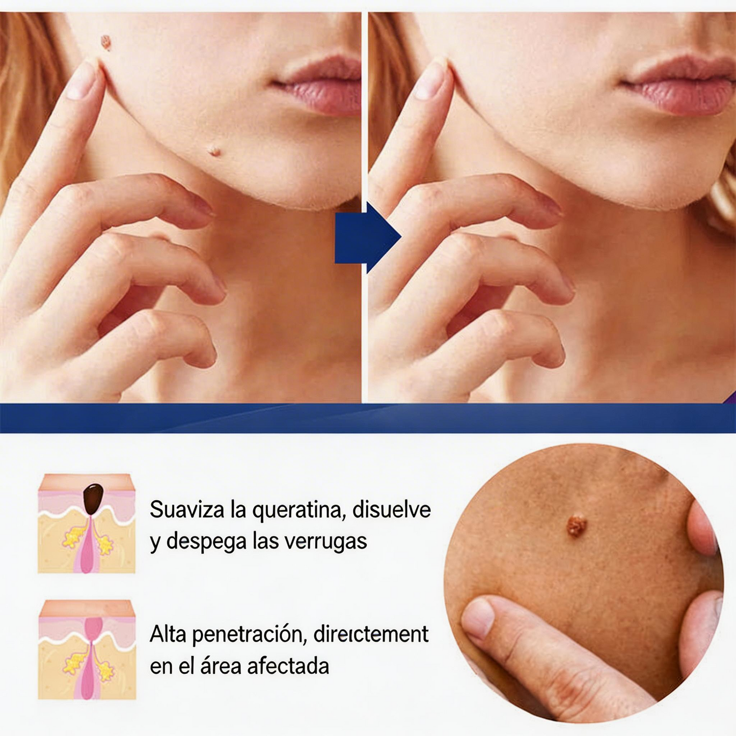 CREMA REMOVEDORA DE VERRUGAS, Piel limpia, segura y libre de preocupaciones.