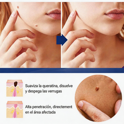 CREMA REMOVEDORA DE VERRUGAS, Piel limpia, segura y libre de preocupaciones.