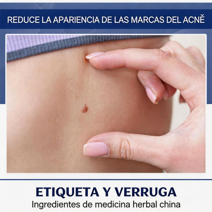 CREMA REMOVEDORA DE VERRUGAS, Piel limpia, segura y libre de preocupaciones.